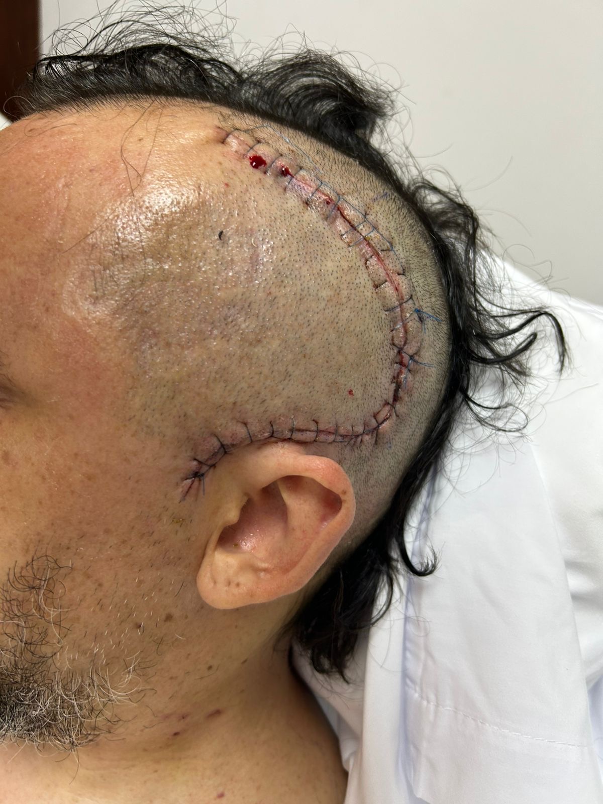 Frank's head showing the surgery stitches, healing well